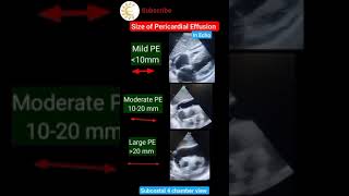 Size of Pericardial effusion in Echo echo ytshortsvideo shortsvideo [upl. by Genvieve]