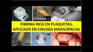 FIBRINA RICA EN PLAQUETAS APLICADO A CBMF [upl. by Reis]