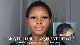 HAIR TRANSPLANT 6 MONTH UPDATE  LONGEVITA [upl. by Yenaiv]