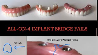 HUGE Failures with All on 4 Dental Implant Bridges [upl. by Viviane]