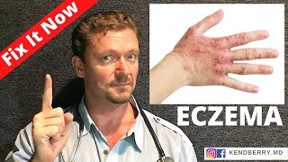 ECZEMA Improve or Reverse Your Eczema NOW 2024 [upl. by Artemisa446]