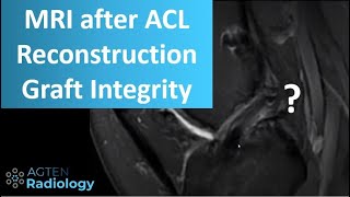 Knee MRI After ACL Reconstruction Surgery [upl. by Glori]