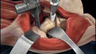 Direct Anterior Approach Hip Replacement [upl. by Ruberta]