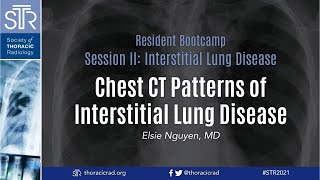 Chest CT Patterns of Interstitial Lung Disease [upl. by Nyar]