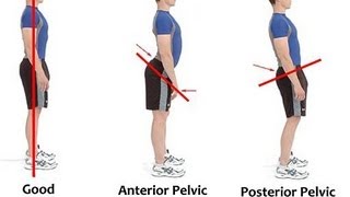 QampA Should I do DEADLIFTS if I have an anterior pelvic tilt [upl. by Tamaru]