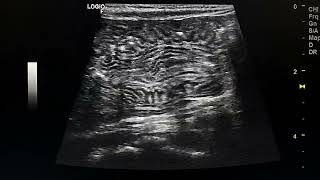 Transient ileoileal nonobstructing intussusception ultrasound video [upl. by Eenehs]