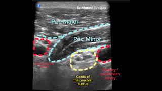 Infraclavicular block with Houdini manoeuvre ultrasound guided [upl. by Malamud]