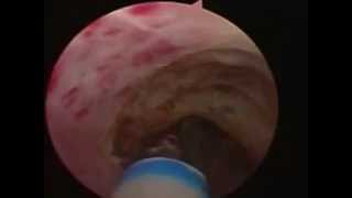 Endoscopic laser urethrotomy Avagyan MC [upl. by Melena441]