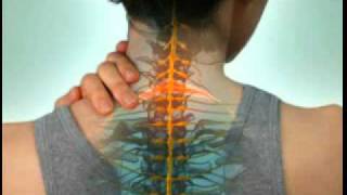 Cervical Radiculopathy  DePuy Videos [upl. by Liagibba]