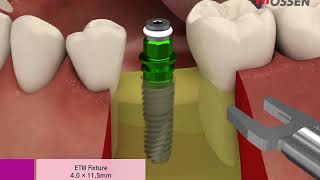 Hiossen ETIII Surgical amp drilling [upl. by Roosevelt]