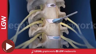 Cervical Discectomy amp Fusion Surgery 3D animation C3 C4 C5 C6 [upl. by Varrian980]