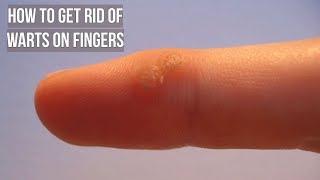 How to Get Rid of Warts on Fingers [upl. by Nanda]