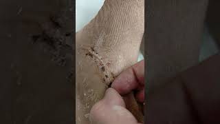 Picking scabs after cast removal 1 [upl. by Enelrae]