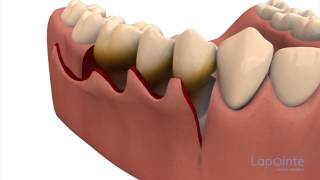 Periodontal flap approach surgery  Lapointe dental centres [upl. by Robbi186]