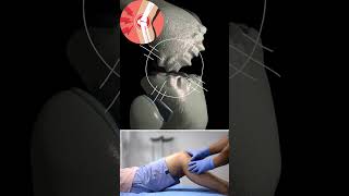 Osteoarthritis Knee  Knee pain  OA Knee [upl. by Esenej208]