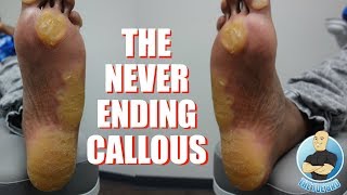 EXTREME UNBELIEVABLE NEVER ENDING THICKEST FOOT CALLUSCALLOUS REMOVAL [upl. by Ready]