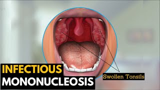 Infectious mononucleosis Causes Signs and Symptoms Diagnosis and Treatment [upl. by Hendon333]