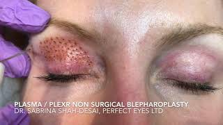 Nanoplasma or Plexr blepharoplasty [upl. by Steward]