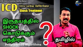 ICD in tamil  intra Cardiac Defibrillator  arrhythmia treatment defibrillation  ps tamil [upl. by Asiulana]