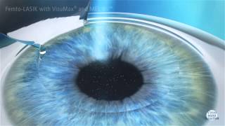 Femto Lasik Opération des yeux par laser  Myopie Hypermétropie Astigmatisme par laser [upl. by Atinad467]