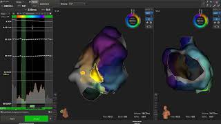 Atypical Right Atrial Flutter Critical Isthmus Identification [upl. by Wilscam]