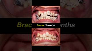 Braces 26 months duration Severely crooked teeth braces orthodontist bracesoff dentist [upl. by Gonta]