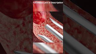 Types of Tubal Ligation🤔  Tubectomy  Laparoscopic  Hysteroscopic [upl. by Egnalos]