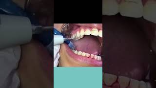 Braces Removal Procedure [upl. by Ayar]