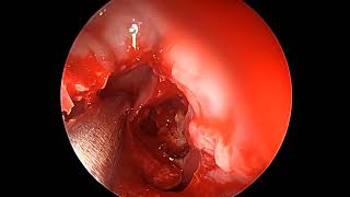 Endoscopic frontal sinusotomy [upl. by Coco]