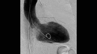 notes on LV angiography  IHD HCM Takotsubo and others [upl. by Ardnossac]