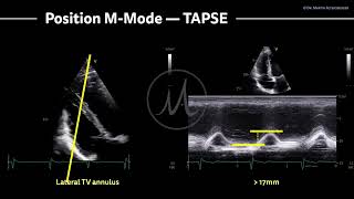 〖Echocardiography〗 TAPSE  right ventricular function with MMode [upl. by Staley]