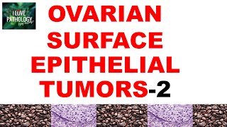 OVARIAN TUMORS  Part 3  ENDOMETRIOID CLEAR CELL amp BRENNER TUMOR Pathology [upl. by Lyrad]