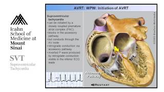 Supra Ventricular Tachycardia [upl. by Yt]