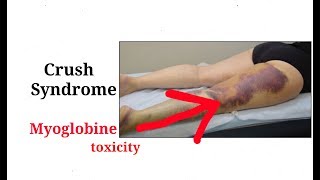 Crush syndrome  rhabdomyolysis  Muscles injuryHindi [upl. by Urian70]