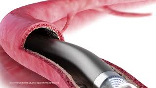 TurboPower laser atherectomy animation [upl. by Yeliab477]