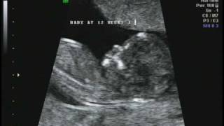 12 weeks 1 day Ultrasound [upl. by Annmarie164]