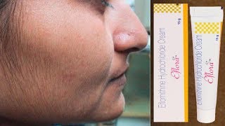 Eflora Cream for Facial Hair Removal  Eflora cream uses in Hindi [upl. by Anselmi]