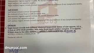 45 mm Fibroadenoma in Breast BiRads  2 Got dissolved by Homeopathy  Homeopathic Treatment [upl. by Joost]