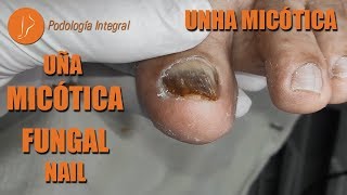 Uña micótica  Fungal nail  Unha micótica Podología Integral [upl. by Lrad]