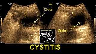 Cystitis  Ultrasound  Case 29 [upl. by Matland4]