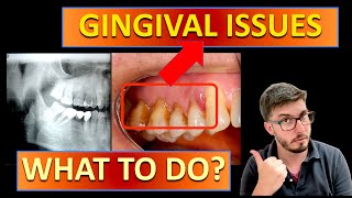 GINGIVITIS treatment vs PERIODONTITIS with TEETH STAINING gingivitis cleaning bleeding [upl. by Attennhoj]