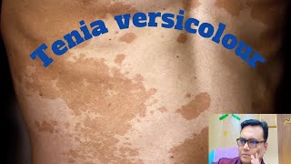 Tinea versicolour treatment Tinea versicolour causes fungal [upl. by Lippold]