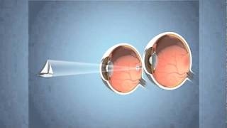 Monovision for Presbyopia [upl. by Marylou466]