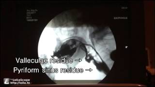 RamsayHunt Syndrome Accompanied by Dysphagia A Videofluoroscopic Swallowing Study [upl. by Ronica]