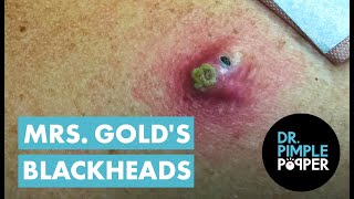 Mrs Golds Back Blackhead Extraction Session  Addressing the Inflamed One [upl. by Adnamra]