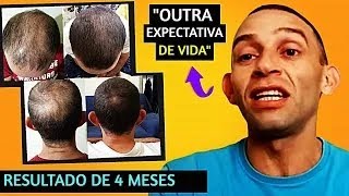 O ADRIANO VENCEU A CALVÍCIE E QUEDA CAPILAR EM APENAS 4 MESES DE TRATAMENTO [upl. by Hillie523]