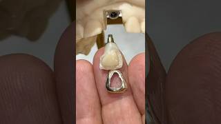 Cementing a Gold Facing lsk121shorts dental teeth [upl. by Kcin402]