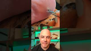 Doctor reacts to fat splinter removal dermreacts doctorreacts splinter splinterremoval [upl. by Niuqaoj]