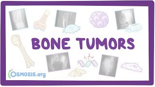 Bone tumors  causes symptoms diagnosis treatment pathology [upl. by Garges959]