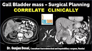 Gall Bladder cancer Surgical planning on CT scan Triphasic CT liver protocol  Correlate clinically [upl. by Gehlbach]